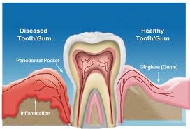 Gum Disease Dentist Chandler Gilbert AZ 85225